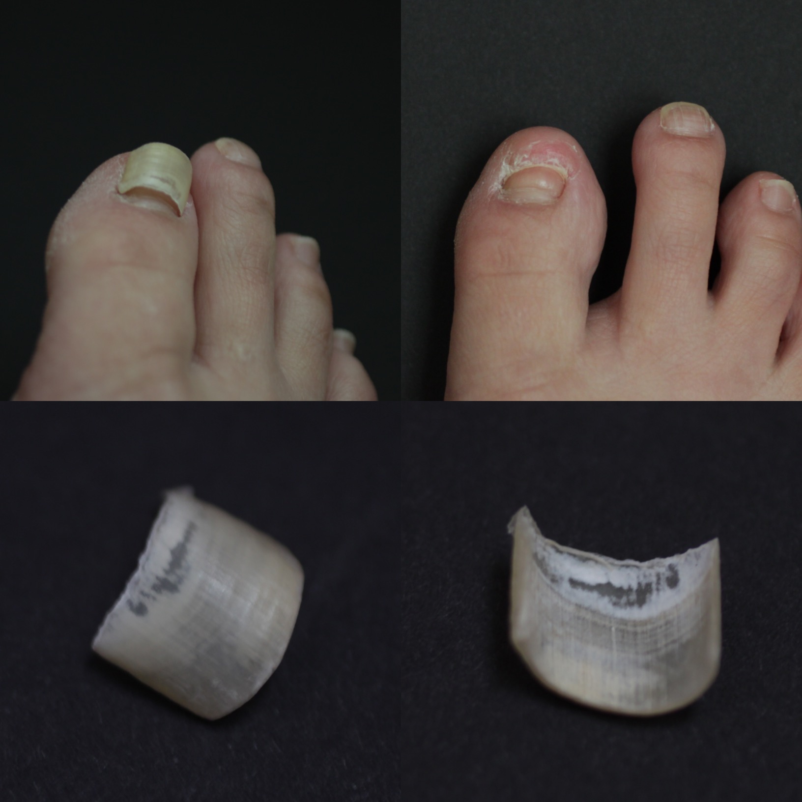 Pedicure Nail Fungus - Nail Ftempo